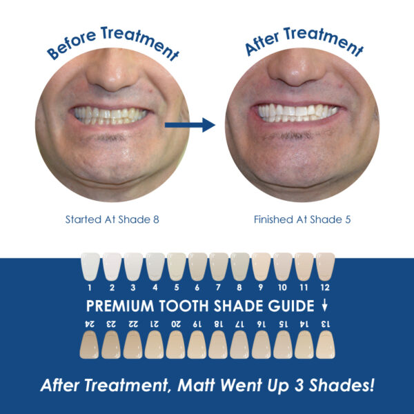 Medidenta - Whiter Image - 9% HP - Prefilled Teeth Whitening Tray Kit - 07